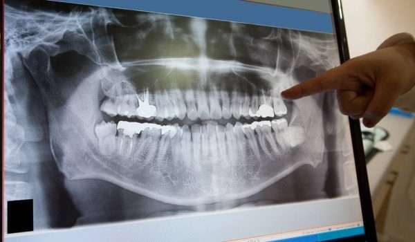 اشعة الاسنان