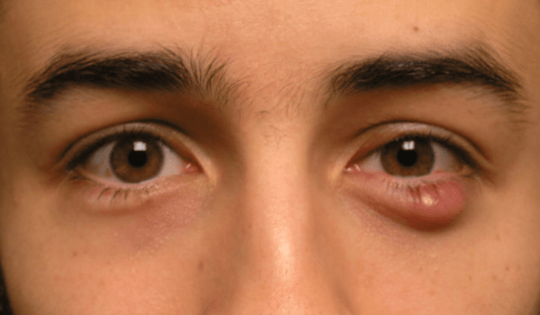الكيس الدهني في العين وعلاجه بالطرق الطبيعية والجراحية - كل يوم معلومة طبية