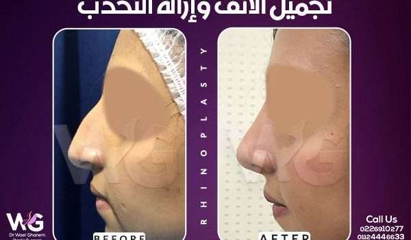 عمليات تجميل الأنف