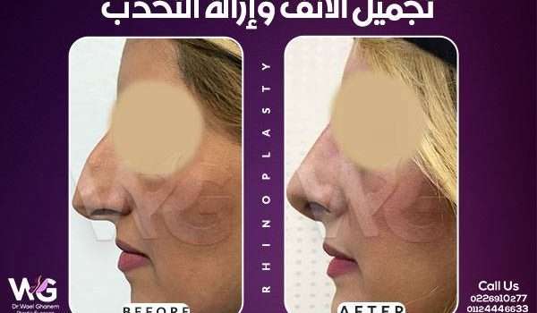عمليات تجميل الأنف