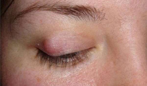 الكيس الدهني في العين وعلاجه بالطرق الطبيعية والجراحية كل يوم معلومة طبية