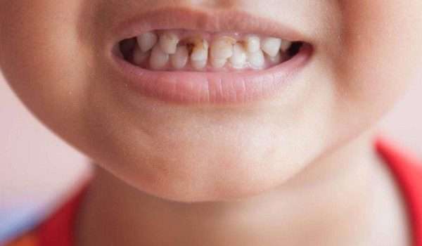 تعرف على أسباب وأعراض تسوس الاسنان عند الاطفال
