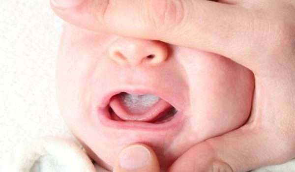 علاج-فطريات-الفم-عند-الرضع-بالاعشاب1