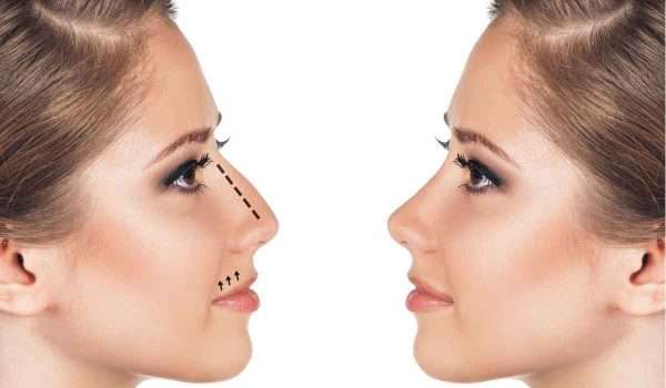 متى-يستقر-شكل-الانف-بعد-عملية-التجميل2