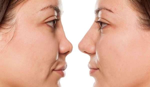 نتائج-عملية-تجميل-الانف