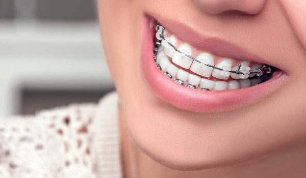 انواع تقويم الاسنان المختلفة وهل التقويم مؤلم للأسنان Nadormagazine Com مجلة الناظور الأولى