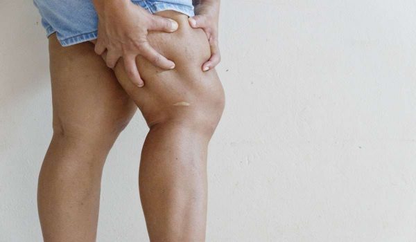 اعراض الجلطة في أحد الذراعين أو الساقين