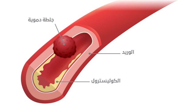 الجلطة